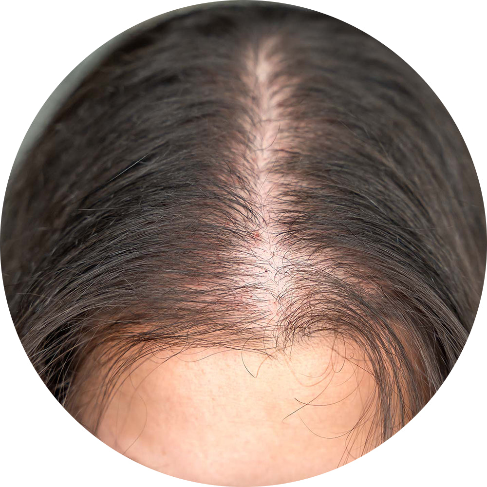 Hormonal Hair Issues