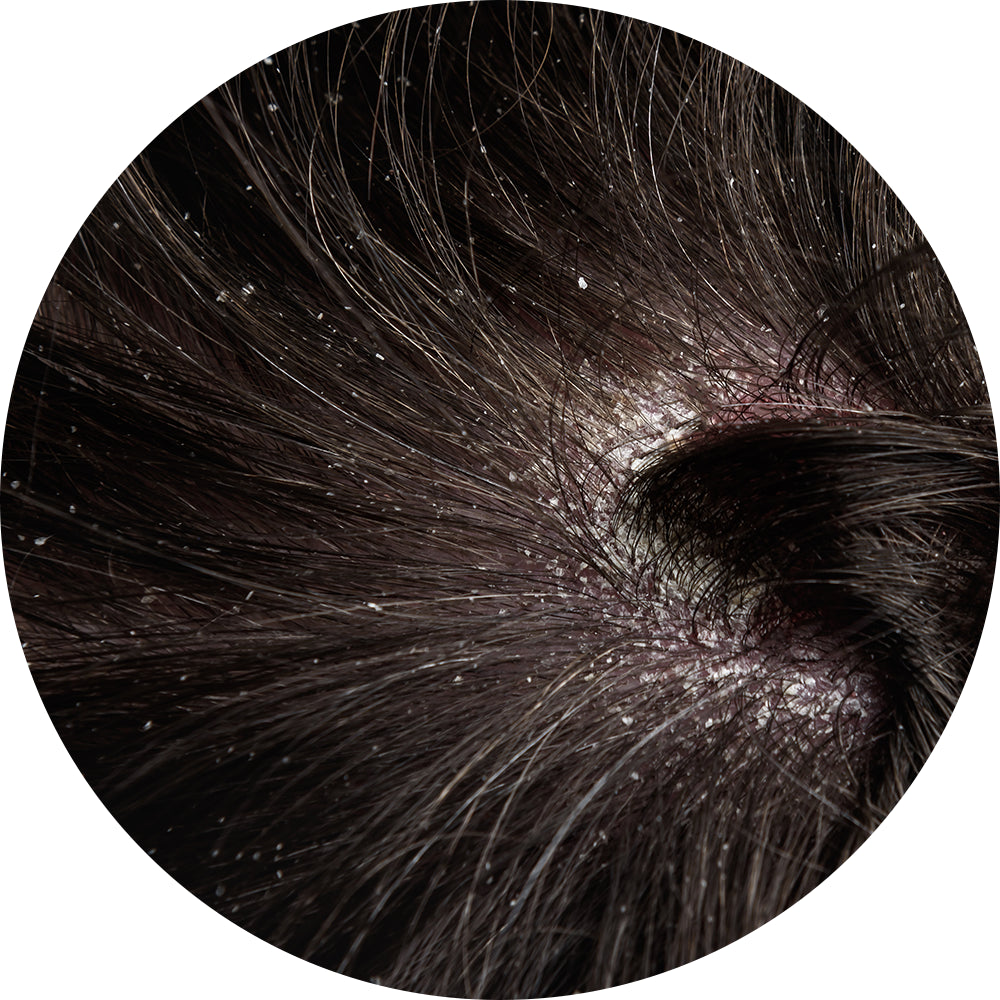 Dry & Flaky Scalp