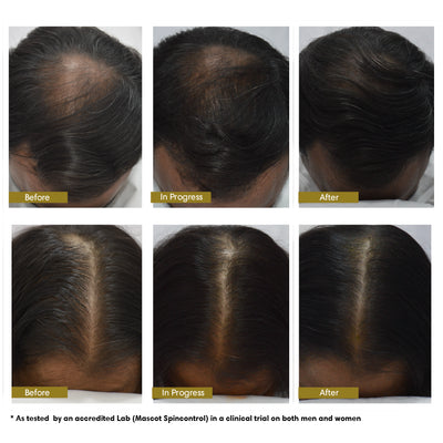 Hair Density Tonic | Intense Hair Fall & Hair Growth | Advanced 3-Level Therapy